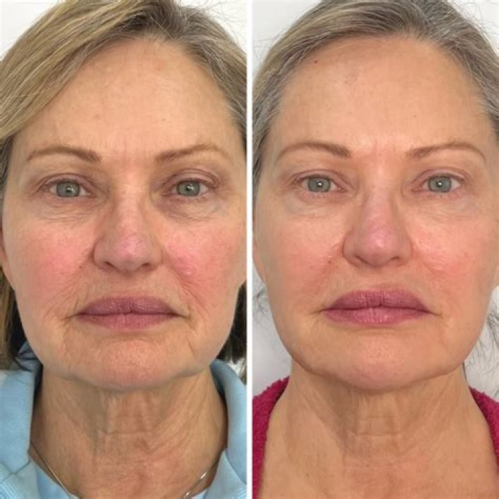 Before And After Pictures Of Actress Swoosie Kurtz’s Plastic Surgery Procedure